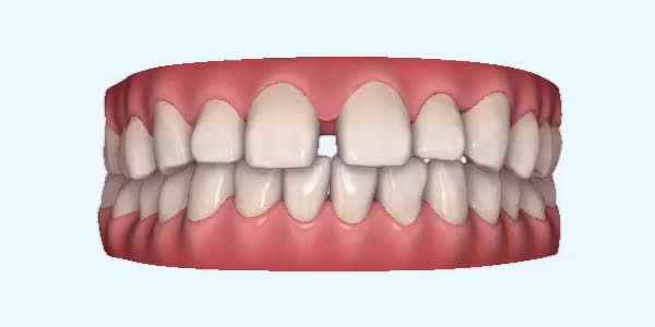 gapped_teeth fix process week 1